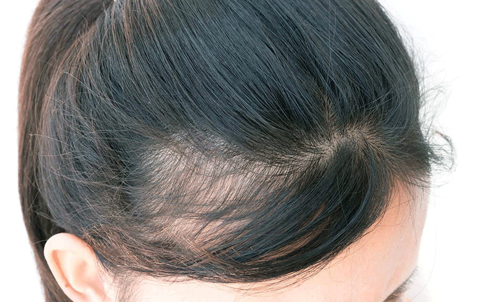 Hair Regrowth With AAPE Product